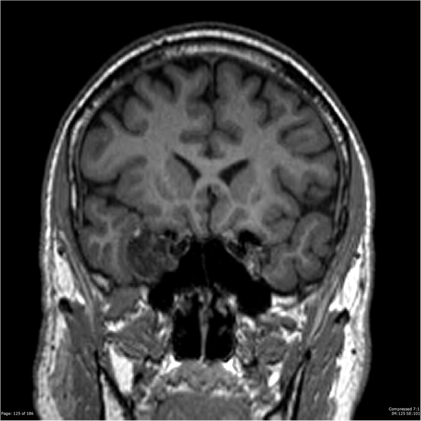 Chondrosarcoma of skull base- grade II (Radiopaedia 40948-43654 Coronal T1 46).jpg