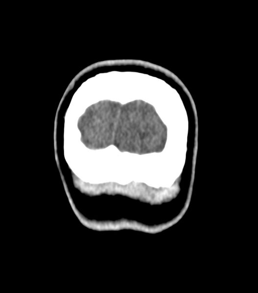File:Choroid plexus carcinoma (Radiopaedia 91013-108552 Coronal non-contrast 83).jpg
