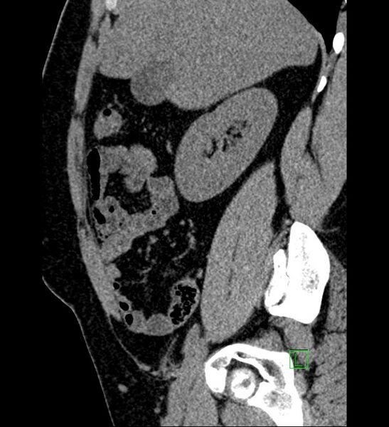 File:Chromophobe renal cell carcinoma (Radiopaedia 84286-99573 C 129).jpg