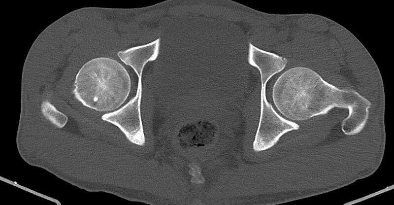 File:Chronic osteomyelitis (with sequestrum) (Radiopaedia 74813-85822 Axial non-contrast 39).jpg