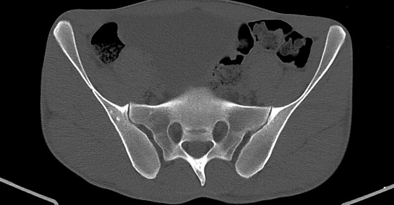 File:Chronic osteomyelitis (with sequestrum) (Radiopaedia 74813-85822 Axial non-contrast 7).jpg