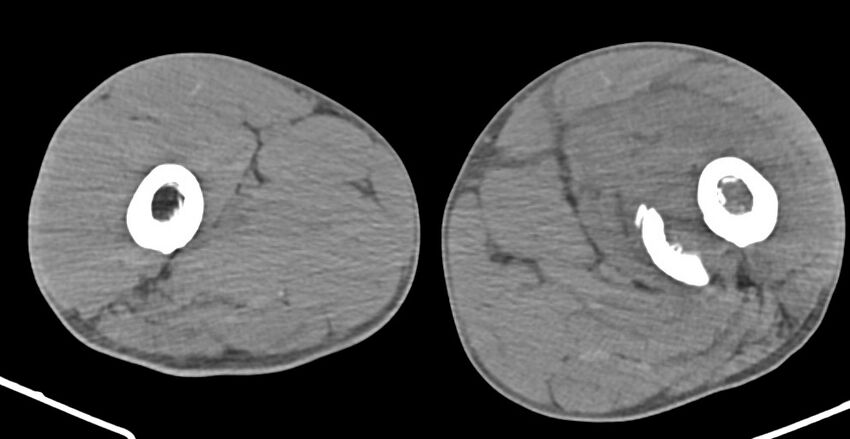 Chronic osteomyelitis (with sequestrum) (Radiopaedia 74813-85822 D 79).jpg