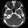 Chronic otomastoiditis (Radiopaedia 27138-27309 Axial non-contrast 29).jpg