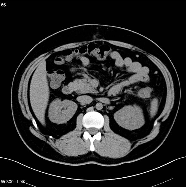 File:Chronic pancreatitis and pseudocysts (Radiopaedia 6724-7935 Axial non-contrast 12).jpg