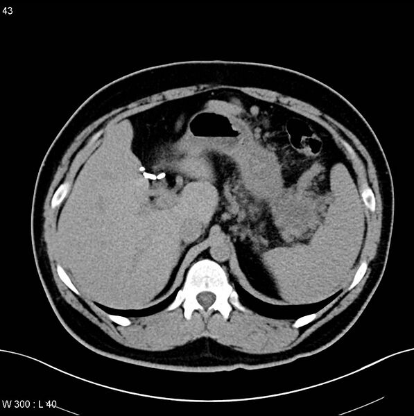 File:Chronic pancreatitis and pseudocysts (Radiopaedia 6724-7935 Axial non-contrast 2).jpg