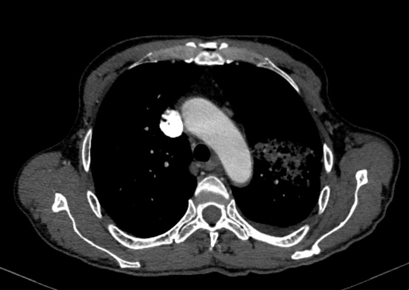 File:Chronic pulmonary embolism with bubbly consolidation (Radiopaedia 91248-108850 C+ arterial phase 37).jpg
