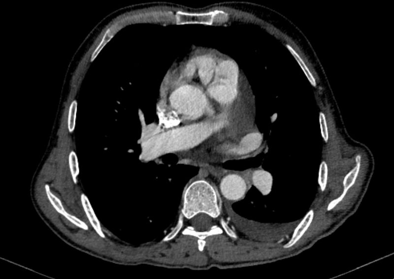 File:Chronic pulmonary embolism with bubbly consolidation (Radiopaedia 91248-108850 C+ arterial phase 75).jpg