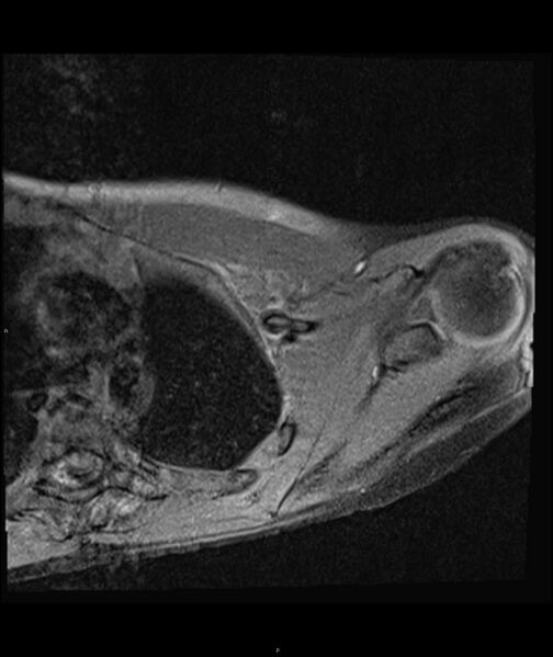 File:Chronic reactive multifocal osteomyelitis (CRMO) - clavicle (Radiopaedia 56406-63071 Axial T1 fat sat 14).jpg