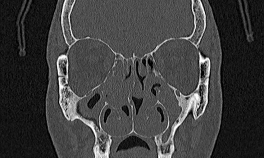 Chronic rhinosinusitis (Radiopaedia 65079-74075 Coronal bone window 35).jpg