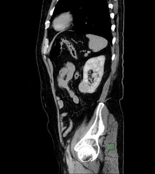 File:Clear cell renal cell carcinoma (Radiopaedia 85006-100539 G 15).jpg