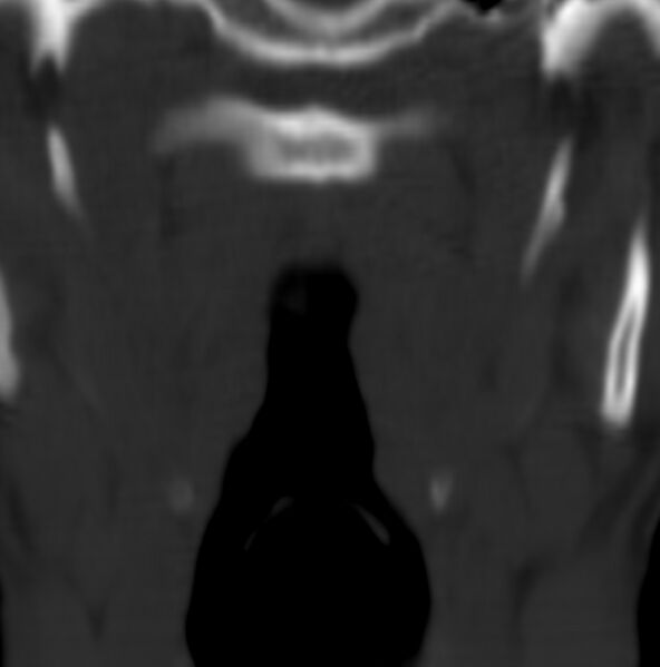 File:Cleft of the posterior arch of C1 mimicking fracture (Radiopaedia 40201-42721 Coronal bone window 18).jpg