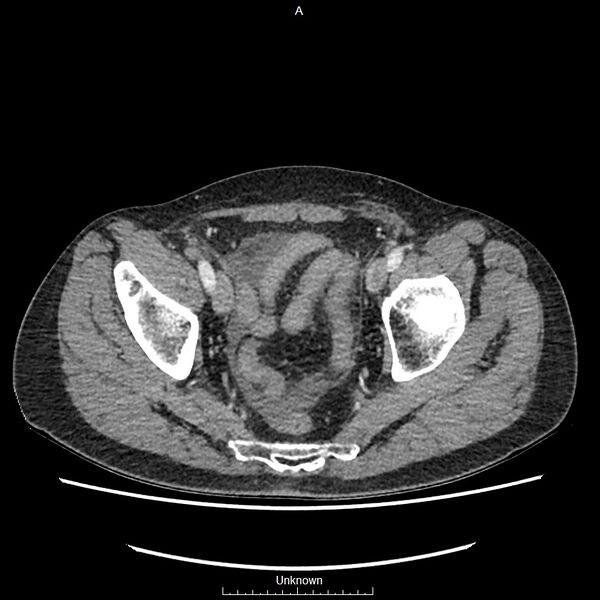 File:Closed loop bowel obstruction and ischemia (Radiopaedia 86959-103180 A 77).jpg