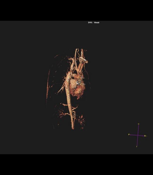 File:Coarctation of the aorta (Radiopaedia 43373-46729 3D reconstruction 1).jpg