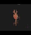 Coarctation of the aorta (Radiopaedia 43373-46729 3D reconstruction 24).jpg