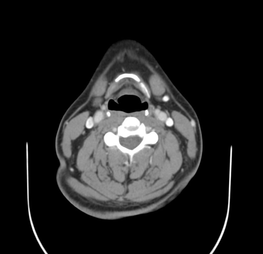 Colloid cyst of thyroid (Radiopaedia 22897-22923 Axial C+ delayed 40).jpg