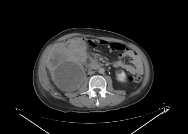File:Colon cancer mimicking renal cell carcinoma (Radiopaedia 28986-29335 Axial C+ delayed 38).jpg