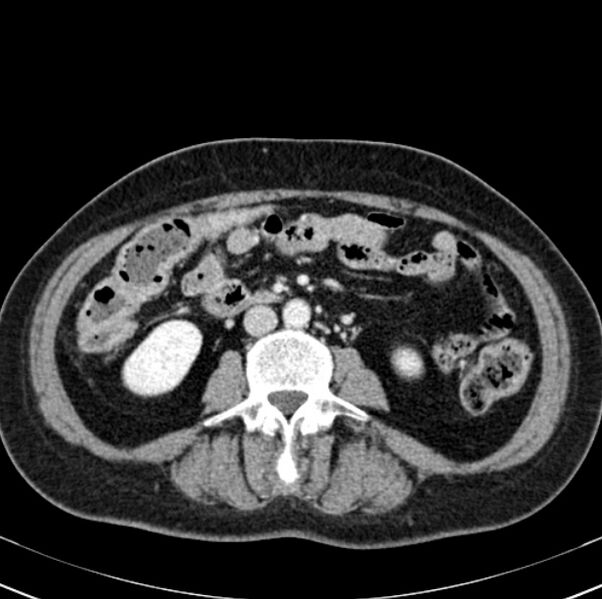 File:Colon carcinoma with hepatic metastases (Radiopaedia 29477-29961 A 60).jpg
