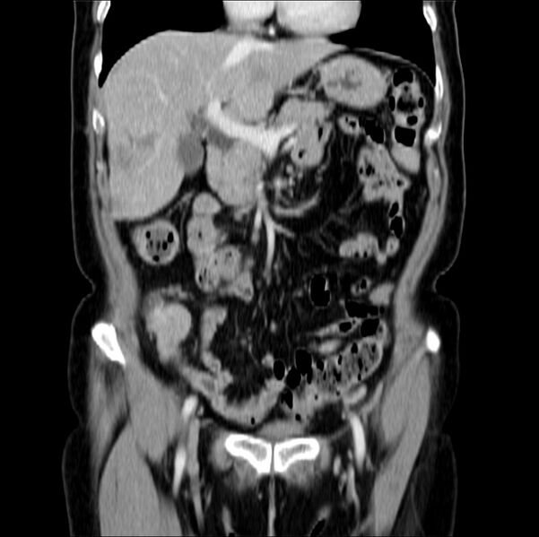 File:Colon carcinoma with hepatic metastases (Radiopaedia 29477-29961 B 17).jpg