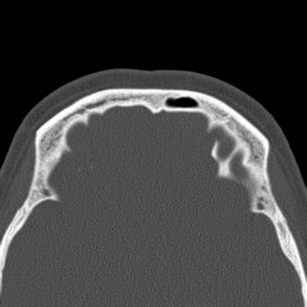 File:Nasolabial cyst (Radiopaedia 33987-35205 Axial bone window 43).jpg