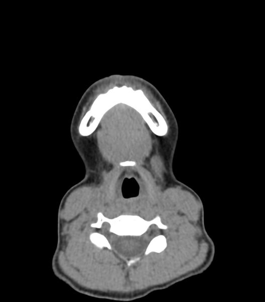 File:Nasoorbitoethmoid fracture (Radiopaedia 90044-107205 Axial non-contrast 36).jpg