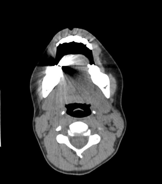 File:Nasoorbitoethmoid fracture (Radiopaedia 90044-107205 Axial non-contrast 66).jpg