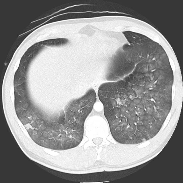 File:Near drowning pulmonary edema (Radiopaedia 16868-16591 Axial lung window 44).jpg