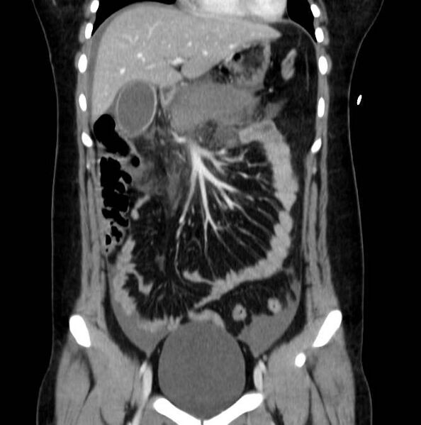 File:Necrotizing pancreatitis (Radiopaedia 23001-23031 B 23).jpg