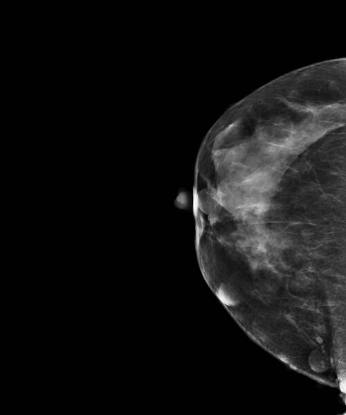 File:Neurofibromatosis of the breast (Radiopaedia 18516-18379 CC 1).jpg