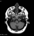 Neurosarcoidosis (Radiopaedia 10930-11351 Axial T1 3).jpg