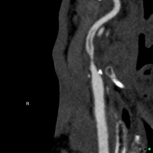 File:Non-occlusive intraluminal internal carotid artery thrombus (Radiopaedia 37751-39658 A 7).jpg