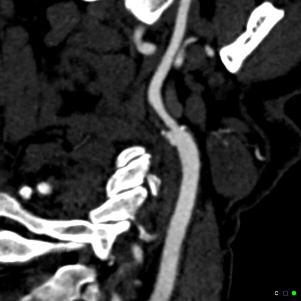 File:Non-occlusive intraluminal internal carotid artery thrombus (Radiopaedia 37751-39658 C 14).jpg