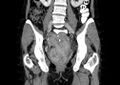 Non-puerperal uterine inversion (Radiopaedia 78343-91094 B 18).jpg