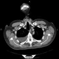 Non Hodgkin lymphoma in a patient with ankylosing spondylitis (Radiopaedia 84323-99624 B 7).jpg