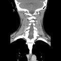 Normal CT of the neck (Radiopaedia 14575-14500 Coronal C+ 38).jpg