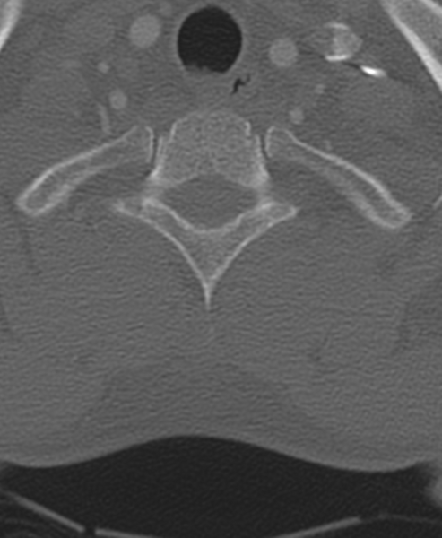 File:Normal CT thoracic spine (Radiopaedia 40181-42688 Axial bone window 11).png