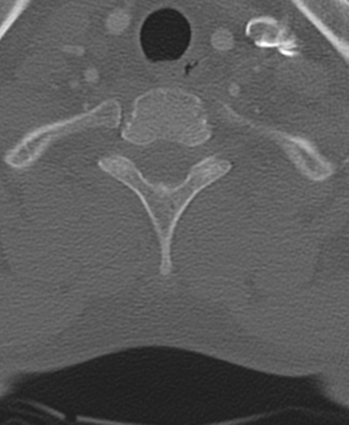 File:Normal CT thoracic spine (Radiopaedia 40181-42688 Axial bone window 12).png