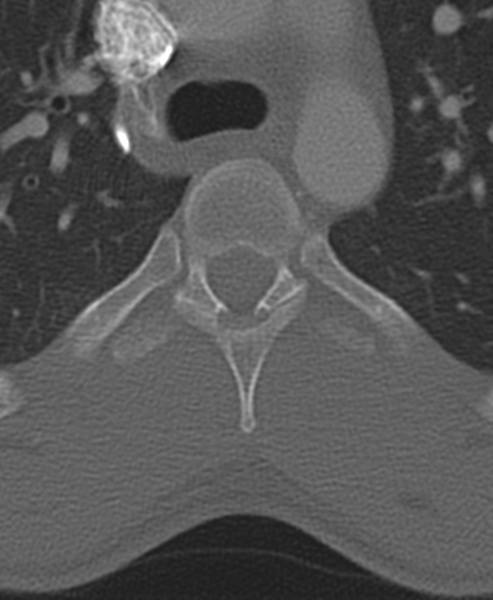 File:Normal CT thoracic spine (Radiopaedia 40181-42688 Axial bone window 35).png