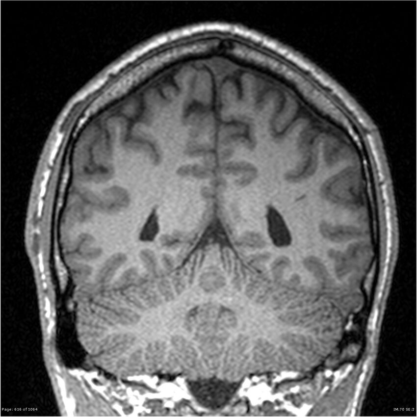 Normal brain MRI (non-focal epilepsy protocol) (Radiopaedia 38571-40700 Coronal T1 34).jpg