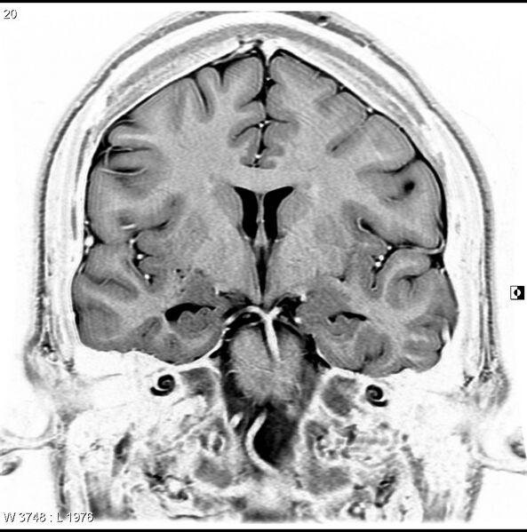 File:Normal coronal brain (Radiopaedia 6676-7910 B 20).jpg