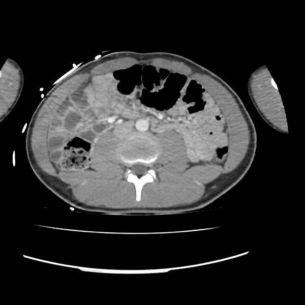 File:Normal dual-phase trauma CT chest,abdomen and pelvis (Radiopaedia 48092-52899 A 76).jpg