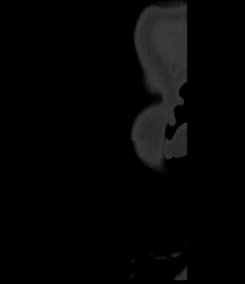 Normal facial bone CT (Radiopaedia 88742-105476 Sagittal bone window 165).jpg