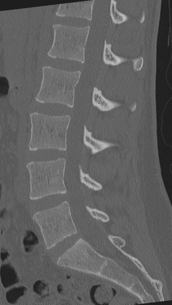 File:Normal lumbar spine CT (Radiopaedia 46533-50986 Sagittal bone window 55).png