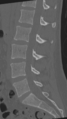 Normal lumbar spine CT (Radiopaedia 46533-50986 Sagittal bone window 55).png