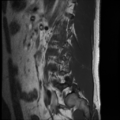 Normal lumbar spine MRI (Radiopaedia 35543-37039 Sagittal T1 1).png
