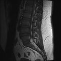 Normal lumbar spine MRI (Radiopaedia 47857-52609 Sagittal T1 11).jpg