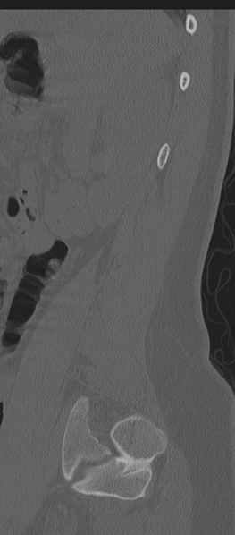 File:Normal lumbosacral CT (Radiopaedia 37923-39867 Sagittal bone window 17).png