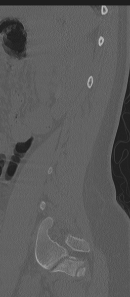 File:Normal lumbosacral CT (Radiopaedia 37923-39867 Sagittal bone window 20).png