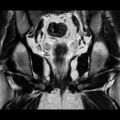 Normal prostate (MRI) (Radiopaedia 29986-30535 Coronal T2 15).jpg