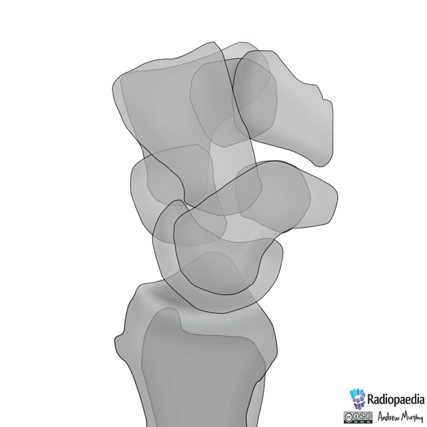 File:Normal wrist alignment, dorsal and volar intercalated segmental instability (illustration) (Radiopaedia 80949-94486 A 8).png