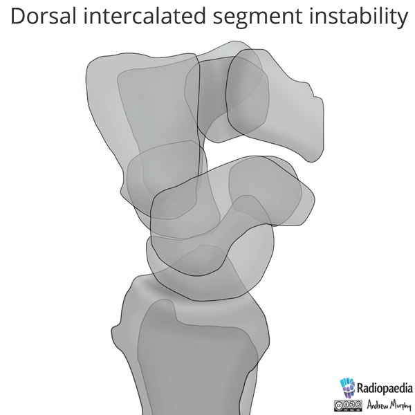 File:Normal wrist alignment, dorsal and volar intercalated segmental instability (illustration) (Radiopaedia 80949-94487 A 2).png